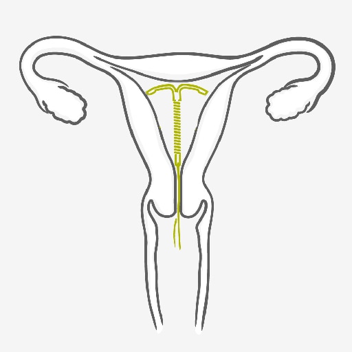 Intrauterine Device - IUD - How to use